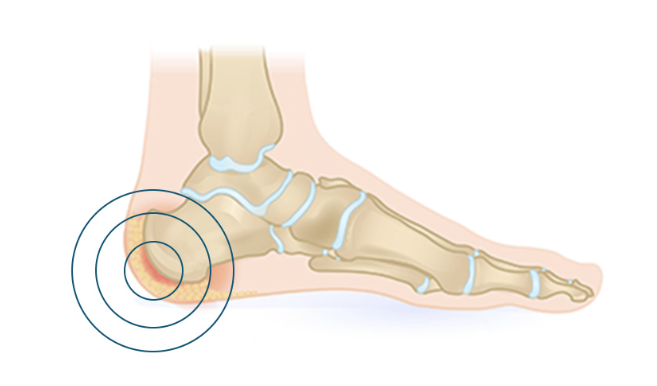What You Should Know About the Common Cause of Heel Pain