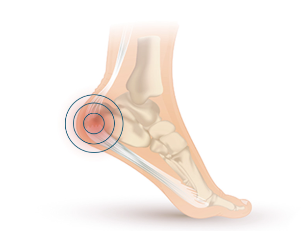 Causes of Plantar Fasciitis