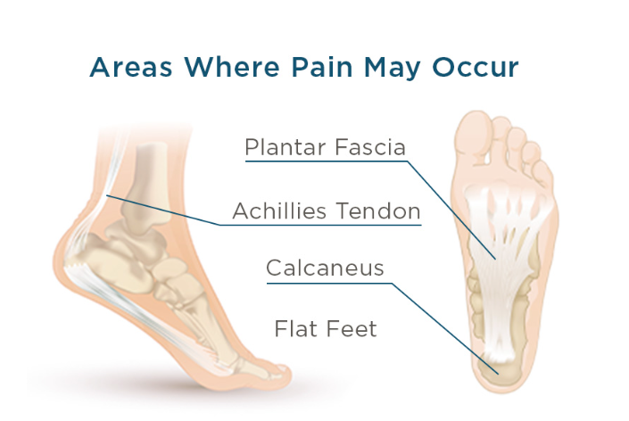 Find Lasting Relief with the Best Plantar Fasciitis Insoles