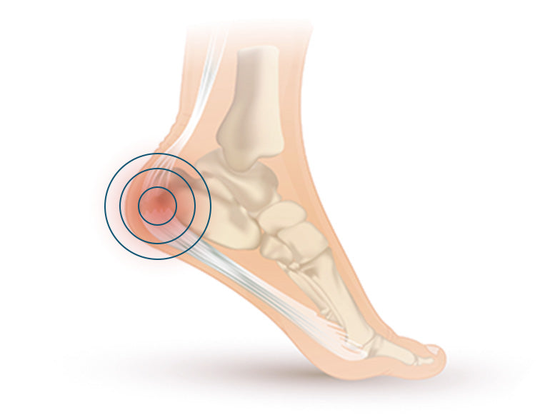Causes of Plantar Fasciitis