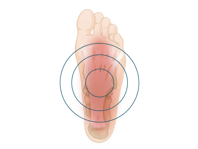 Treatment Options for Plantar Fasciitis